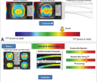 Detecting Early Keratoconus and Avoiding Iatrogenic Ectasia The SCORE Analyzer
