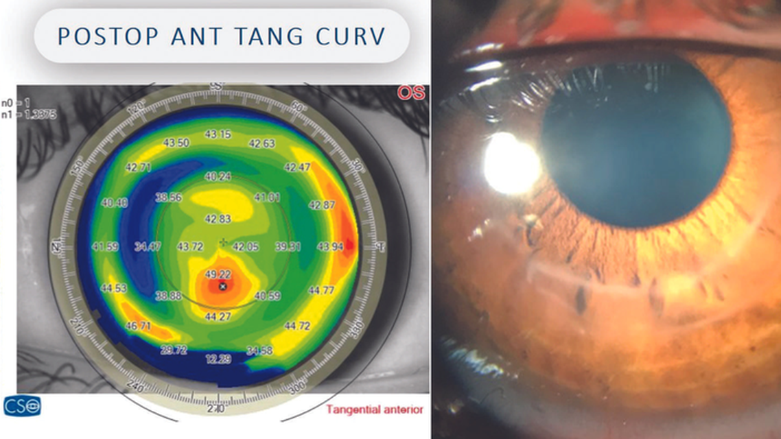 Therapeutic Refractive Surgery for Keratoconus