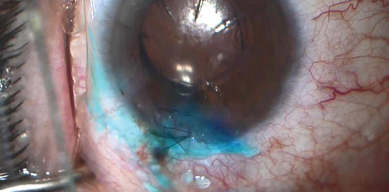Wound Sealing and Stromal Hydration
