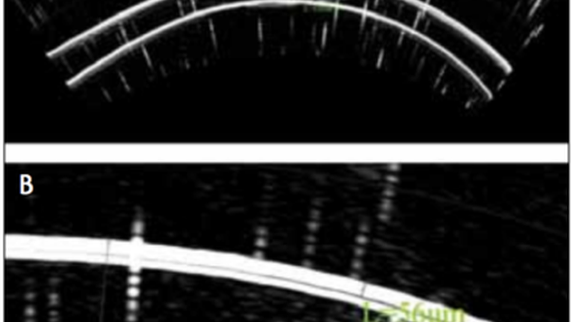 Epithelial Thickness An Indicator for Early Keratoconus