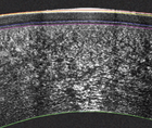 Layer by Layer Multi Zonal Thickness Mapping Unlocks a New Dimension in Corneal Diagnostics