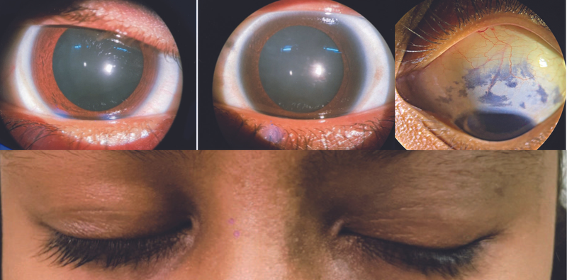 Nevus of Ota