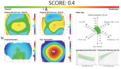 Detecting Early Keratoconus and Avoiding Iatrogenic Ec...