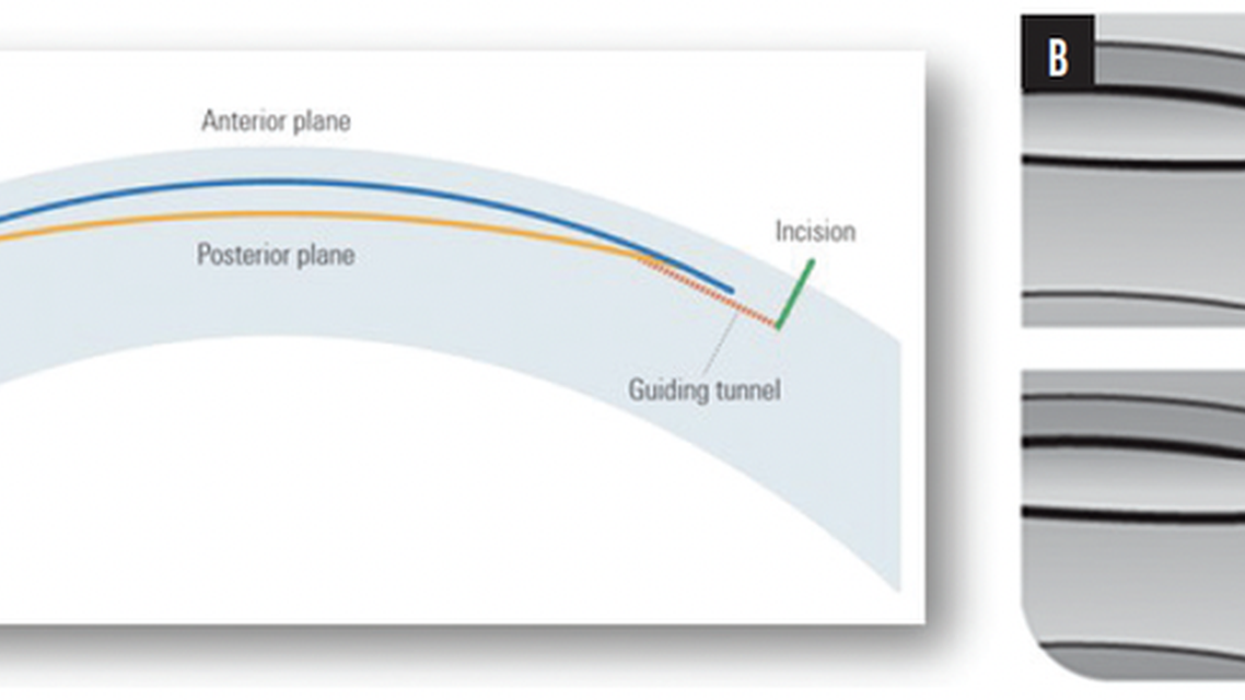 The CLEAR Advantage for Corneal Aberrations