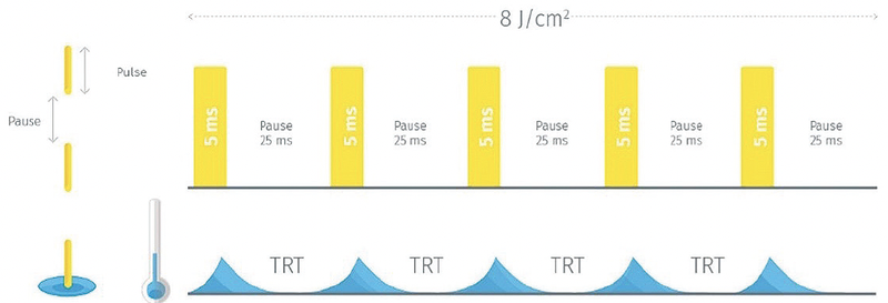 Management of Dry Eye Disease With Intense Pulsed Light IPL