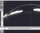 Refractive Surgery and Glaucoma