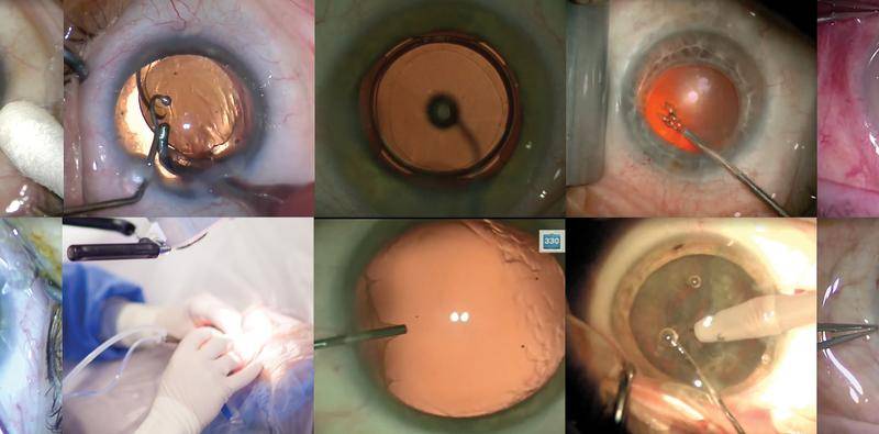 Routine Surgery Using the Femtosecond Laser