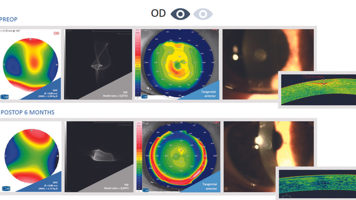 Customized Treatments for Patients With Poor Visual Acuity