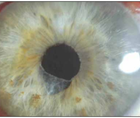 Complications of Small Pupil Cataract Surgery