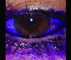 Dye Enhanced Laser Conjunctivoplasty for Conjunctivochalasis