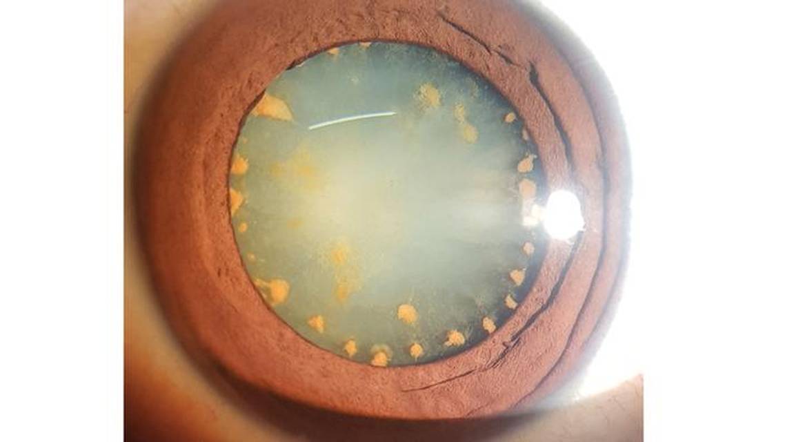 Ocular Siderosis Without a Detectable Intraocular Foreign Body