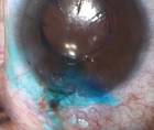 Wound Sealing and Stromal Hydration