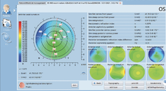 Clinical Value and Use of the Eyestar 900s Cataract Suite