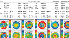 Satisfaction With a Trifocal IOL in One Eye Not Both