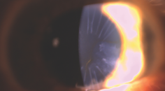 A Patient With Dry AMD Desires Improved Vision