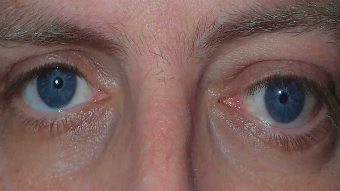 Managing Thyroid Eye Disease