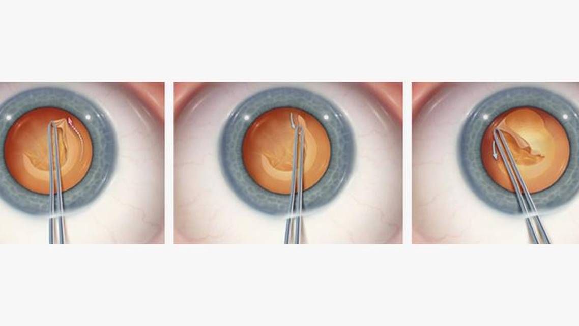Managing the Errant Capsulorhexis