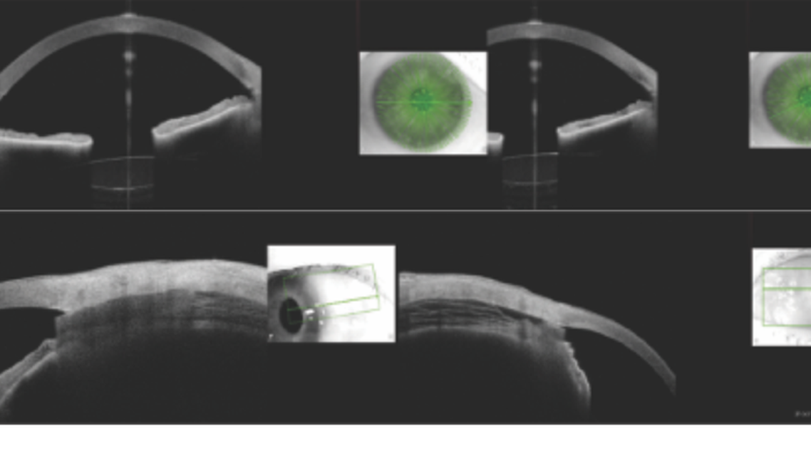 The Role of Anterior Segment OCT in MIGS