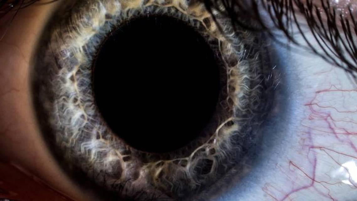 Case Studies in Pupil Dilation