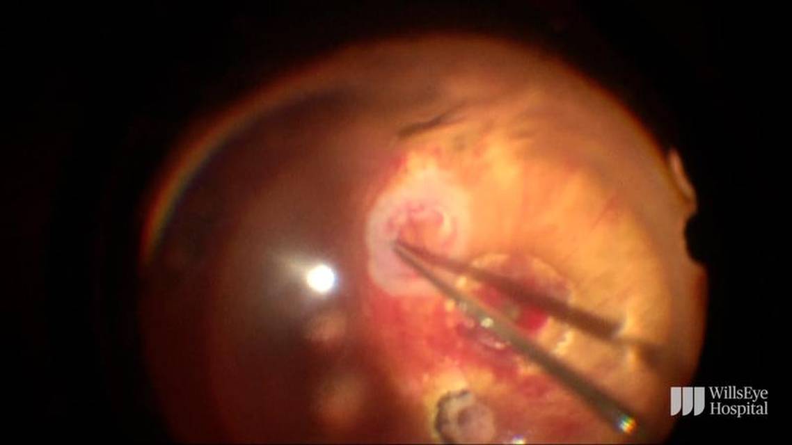 Autologous Retinal Transplant for a FullThickness Macular Hole thumbnail