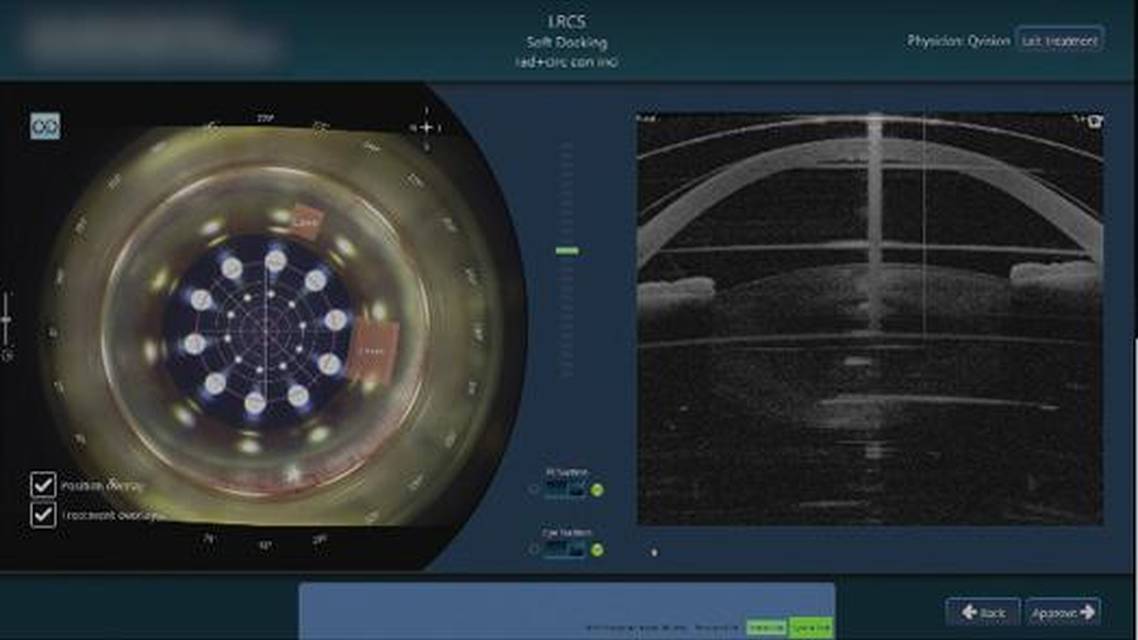 The Complete Refractive Cataract Surgery Package