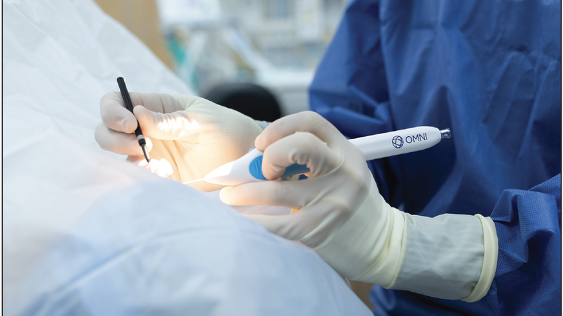 Unparalleled Versatility in Implant Free MIGS