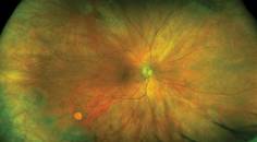 Use of UWF Retinal Imaging in Cataract Surgery