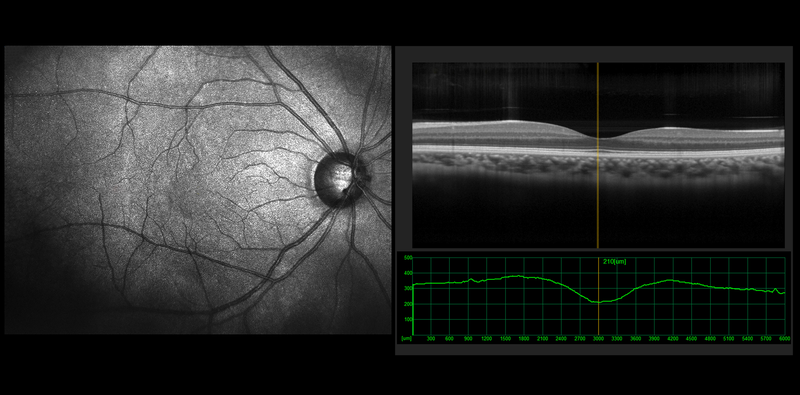 Macular OCT Imaging Before Cataract Surgery