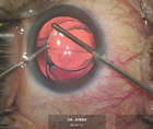 Postoperative Anisometropia
