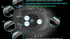 Trabecular Micro Bypass for the Treatment of Glaucoma