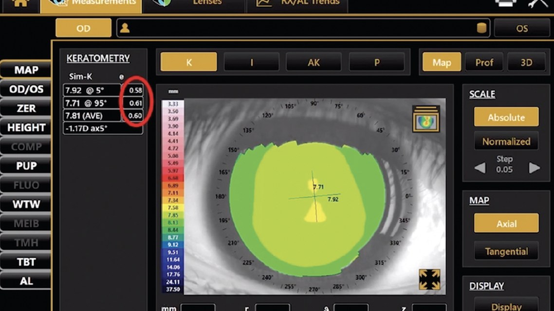 Elevating Your Orthokeratology Fitting Using Topography and Biometry for Myopia Control
