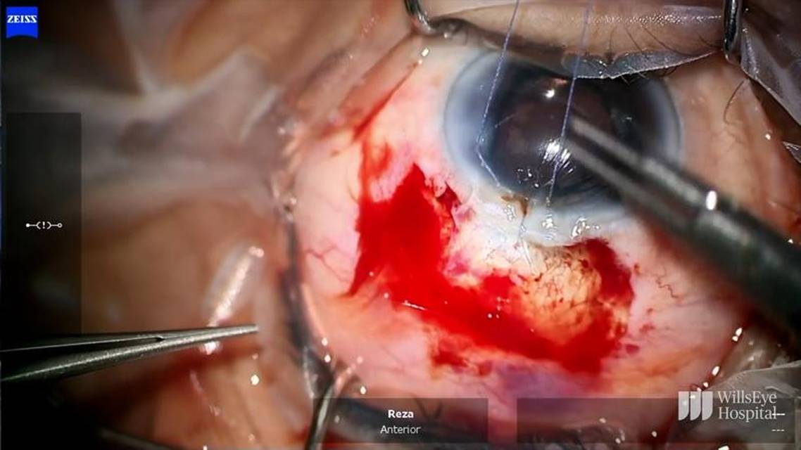 Phacoemulsification Bleb Excision and Tube Shunt Surgery thumbnail