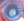 Figure 5. A hypermature cataract with phacolytic glaucoma and lens matter in the anterior chamber.
