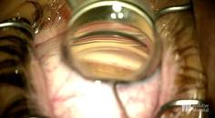 Combining Cataract and Glaucoma Surgery thumbnail