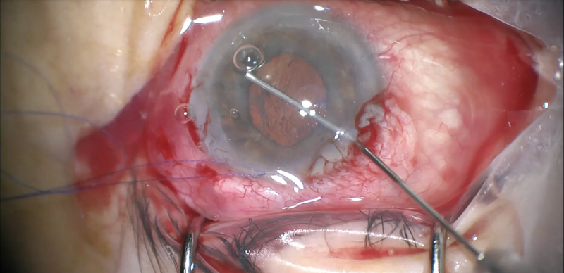 Sulcus Tube Shunt Synechialysis and IridoZonuloHyaloid Vitrectom thumbnail