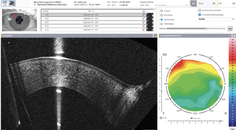 Augmented Awareness Supporting the Review Process with AI based Anomaly Detection in Corneal OCT