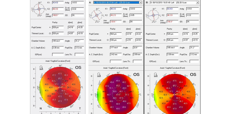High Astigmatism and Amblyopia