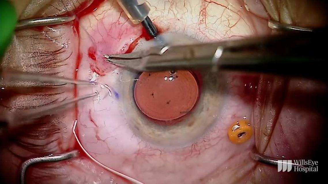 Repositioning a Dislocated Multifocal IOL With the Yamane Technique thumbnail