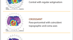 Treatment of Stable Keratoconus