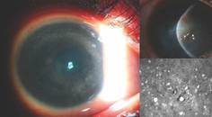 Acanthamoeba Keratitis