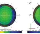 Optimization of Surgical Treatments in the Cornea
