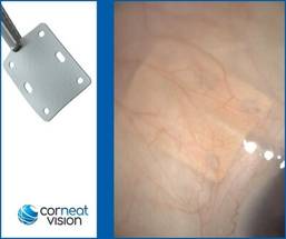 CorNeat EverPatch Synthetic Tissue Substitute Now Available in the US image