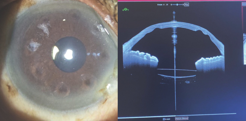 Atypical Corneal Flattening