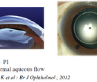 EVO Visian ICL 10 Years of Follow Up