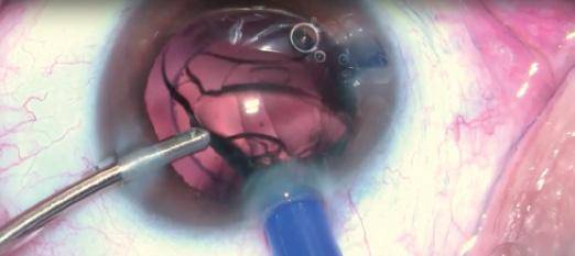 LACS and the FEMTIS IOL Best Practices With the CapsuLaser