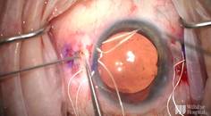 Management of Extensive Cyclodialysis Clefts thumbnail