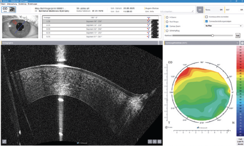 Augmented Awareness Supporting the Review Process with AI based Anomaly Detection in Corneal OCT