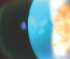 High Myopia After Cataract Surgery