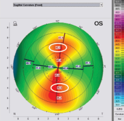 A 12-Point Algorithm to Master Corneal Tomography