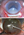 Figure 6. Small-incision cataract surgery being performed in hard, mature cataracts (A,B).